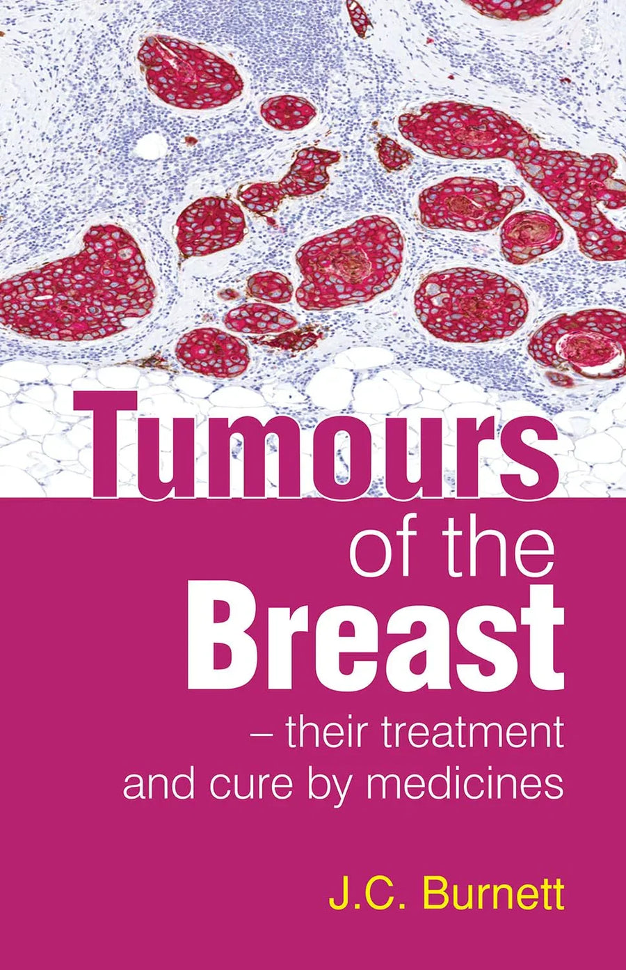 Tumours Of The Breast – Treatment and Cure By Medicine